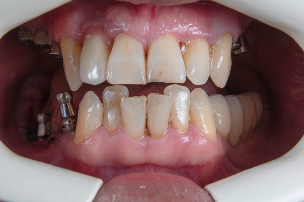 Dental treatment